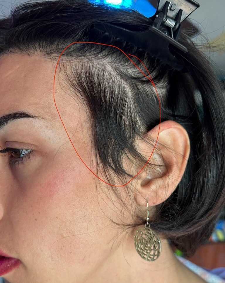 Injerto capilar en cicatrices: recuperar cabello donde parecía imposible